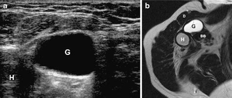 Intratendinous Ganglion Of The Long Head Of The Biceps Tendon Us And Mri Features B