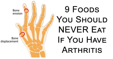 Foods You Should Never Eat If You Have Arthritis