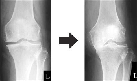 Medial Joint Space Width Was Defined As The Distance Between The Apex