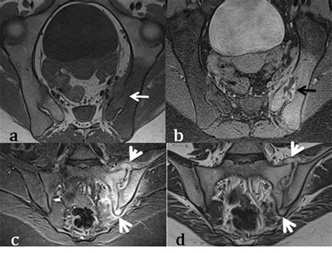 Magnetic Resonance Imaging Of The Sacro Iliac Joint Sij A Axial T1w