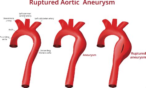 Abdominal Aortic Aneurysm Screenings And Why They Are