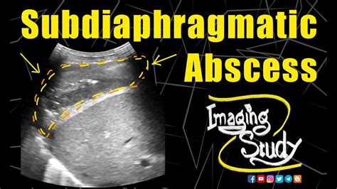Subdiaphragmatic Abscess Subphrenic Abscess Ultrasound Case