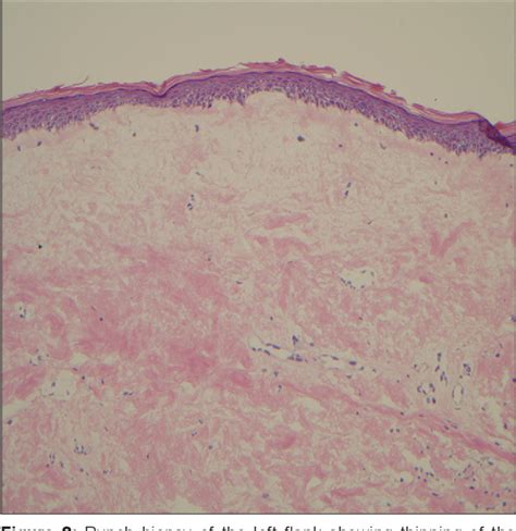 Figure 2 From Disseminated Extragenital Bullous Lichen Sclerosus