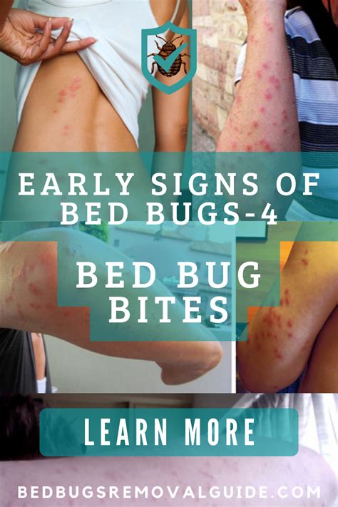 Some People With Bed Bugs On Their Butts And The Words Early Signs Of