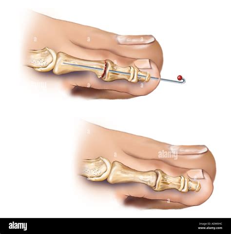 Hammer Toe Post Surgical Condition Stock Photo Alamy