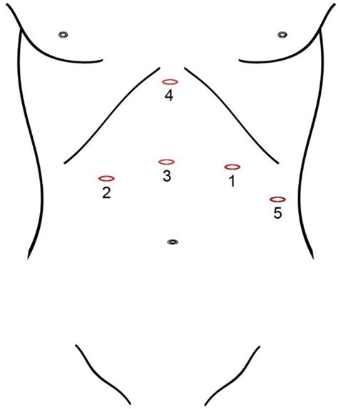Port Placement During Laparoscopic Repair Of Hiatal Hernia With