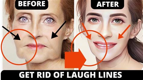 Smile Lines Facial Exercises For Begginers Nasolabial Folds And Laugh