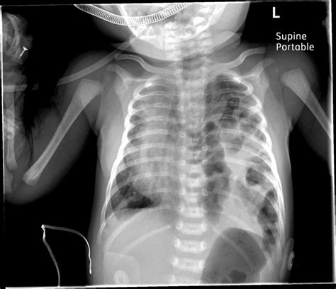 Diaphragmatic Hernia X Ray
