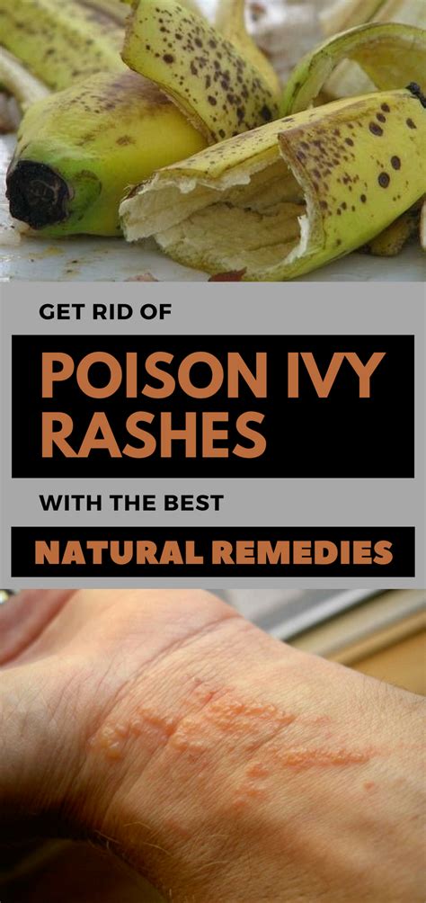 Get Rid Of Poison Ivy Rashes With The Best Natural Remedies Poison