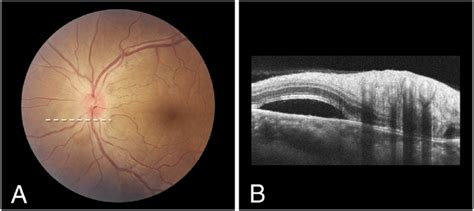 A Fundus Photograph Of The Left Eye Showing Optic Disc Swelling With