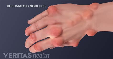 Hand Rheumatoid Arthritis Signs And Symptoms