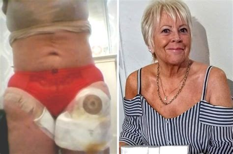 Pensioner Spent Life Savings On Botched Polish Boob Job To