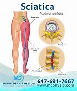 Chiropractic Treatment For Sciatica Photos