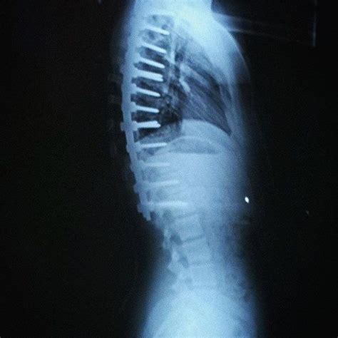 Spinal Fusion X Ray Medizzy