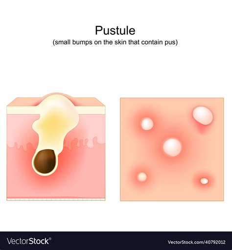Acne Pustule Cross Section Of A Human Skin Hair Vector Image
