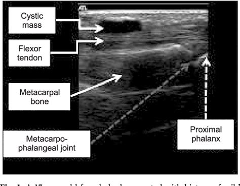 Figure 1 From Ganglion Of The Flexor Tendon Sheath Between A1 Pulley
