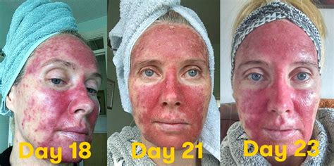 Chemo For Skin Cancer On Face Cancerwalls