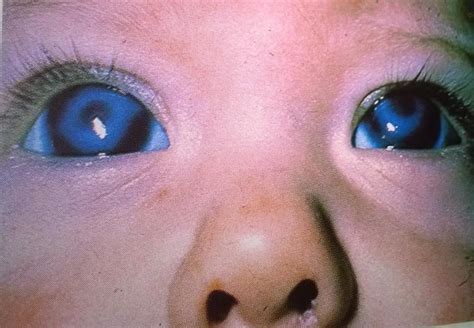 Congenital Cataracts In A Baby Caused By The Rubella Virus Otherwise