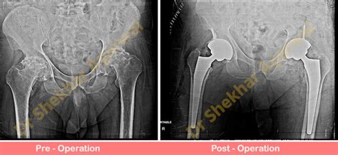 Bilateral Primary Total Hip Replacement Dr Shekhar Agarwal