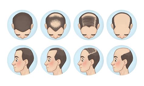 Male pattern baldness - healthand.com