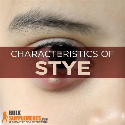 Tablo Read Stye Characteristics Causes And Treatment By