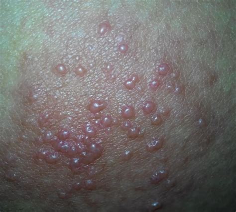 皮肤出现丘疹、红斑、小水泡，还剧烈瘙痒是怎么回事？患者