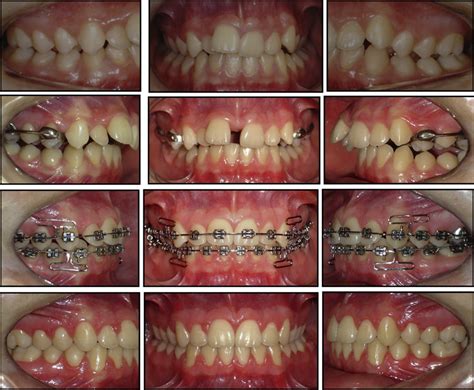Clinical Photographs Of Orthodontic Treatment From Pretreatment To Download Scientific Diagram