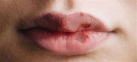 How To Avoid Bruising After Lip Fillers Dr Amiya Prasad Blog