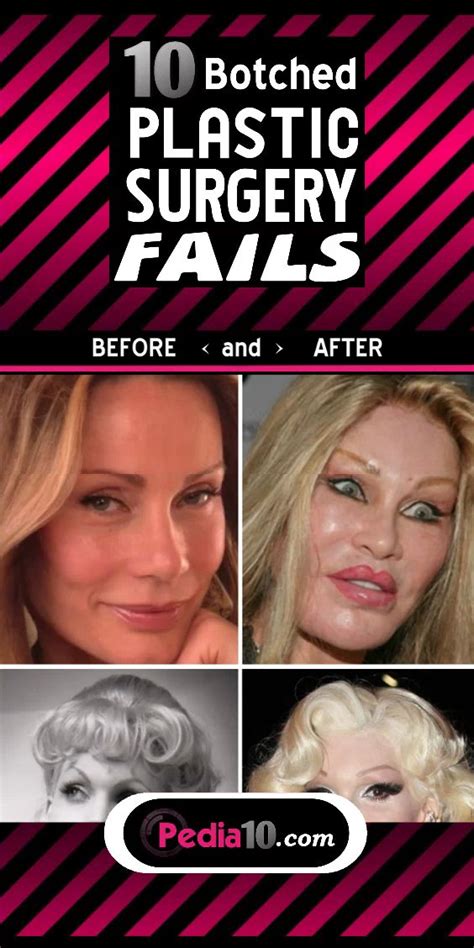 Top Botched Plastic Surgery Fails Before And After Photos In