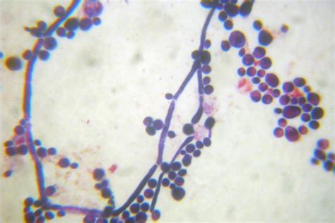Clinical Microbiology Photoblog Candida Gram Stained Smear