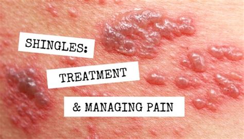 Which Of The Following Is Used To Treat Shingles Tianna Has Martinez