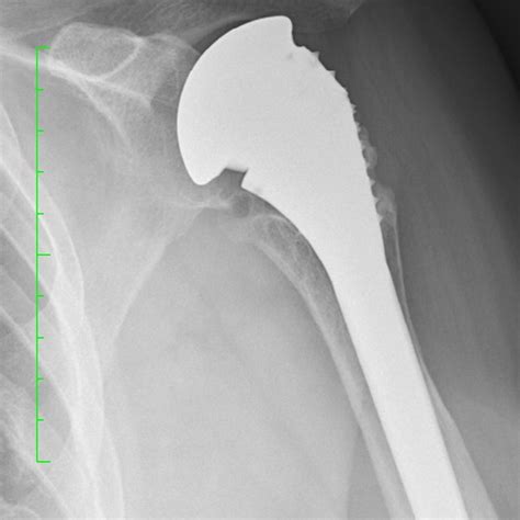 Right Total Hip Arthroplasty And Left Hip Resurfacing Download