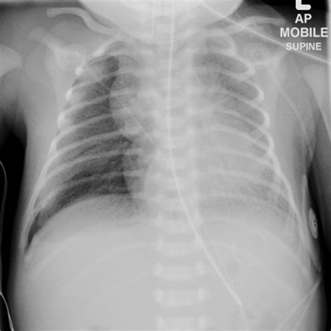 Jul 02, 2021 · the disease is mainly caused by a lack of a slippery substance in the lungs called surfactant. Hyaline membrane disease