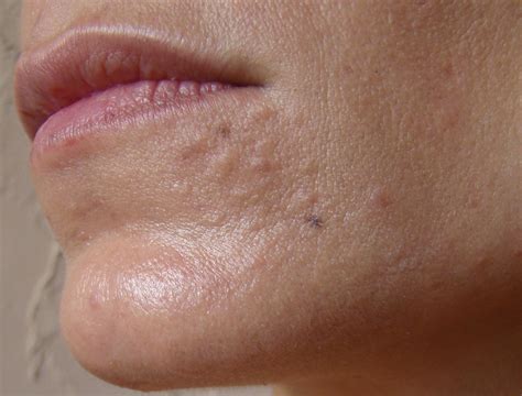 Nose Bumps Scar Treatments By Sandy100 Community
