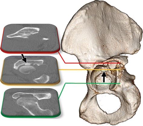 Acetabular Fractures What Radiologists Should Know And How 3d Ct Can
