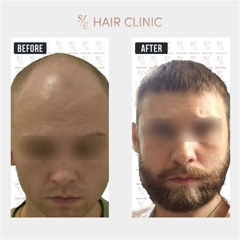 Se Hair Clinic Hair Transplant In Antalya Turkey Hair Transplant In Antalya Turkey