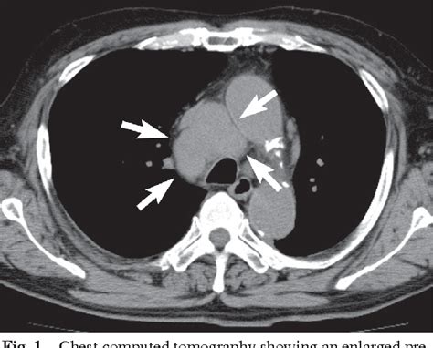Figure 1 From Solitary Bulky Mediastinal Lymph Node Metastasis From