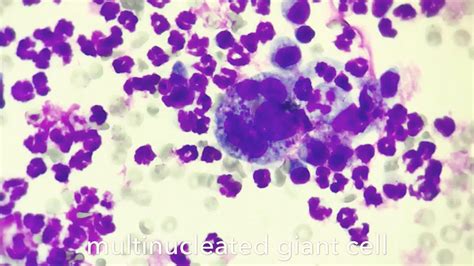 Multinucleated Giant Cells In Cytology Youtube