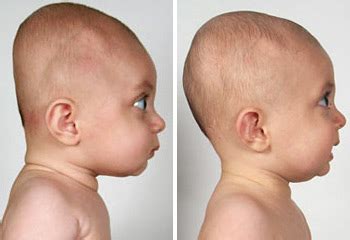 Most flattening will correct itself but if you're concerned about flat head syndrome, we've got all the info here. Flat Head Syndrome - New Kids Center