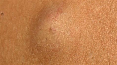 Swelling On Skin Could Be Sebaceous Cyst
