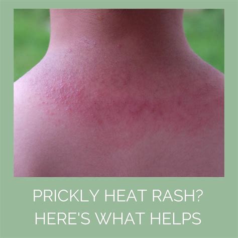 Prickly Heat Rash Causes Prevention And Treatment Odylique