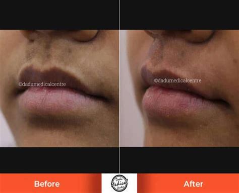 Real Results Before And After Photos Of Upper Lip Laser Hair