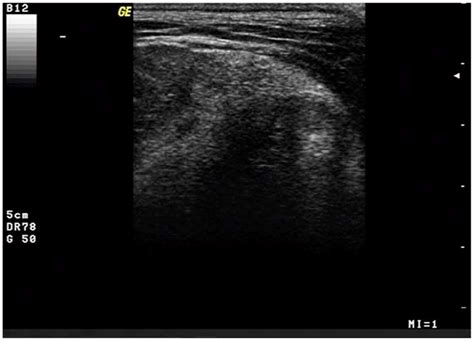 Ultrasound Image Of An Intermuscolar Lipoma An Intermuscular Lipoma Of