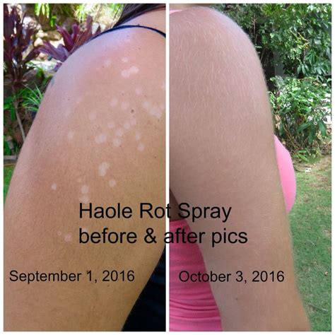Pin On Bad Case Of Tinea Versicolor Puts Haole Rot Spray To The Test