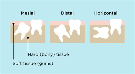 Your Guide To Wisdom Teeth Removal Delta Dental