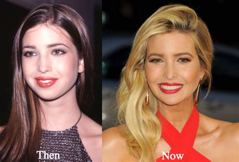 Ivanka Trump Plastic Surgery Before And After Photos