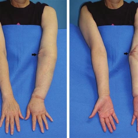 Pdf Greater Omental Lymph Node Flap For Upper Limb Lymphedema With
