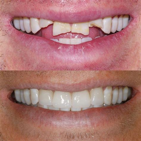 Chipped Teeth Can Be Fixed With Resin Composite Dental Emergency