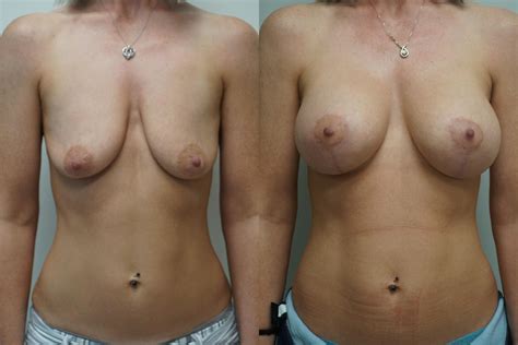 Breast Lift Before After Photos Patient Gilbert Az Dr Josh