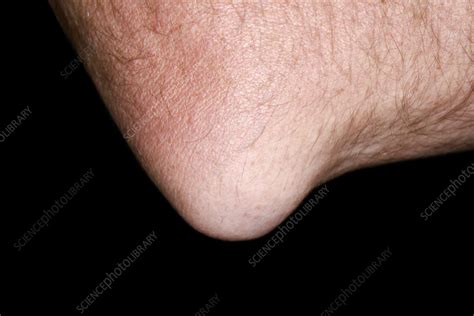 Bursitis Of The Elbow Stock Image C0582275 Science Photo Library
